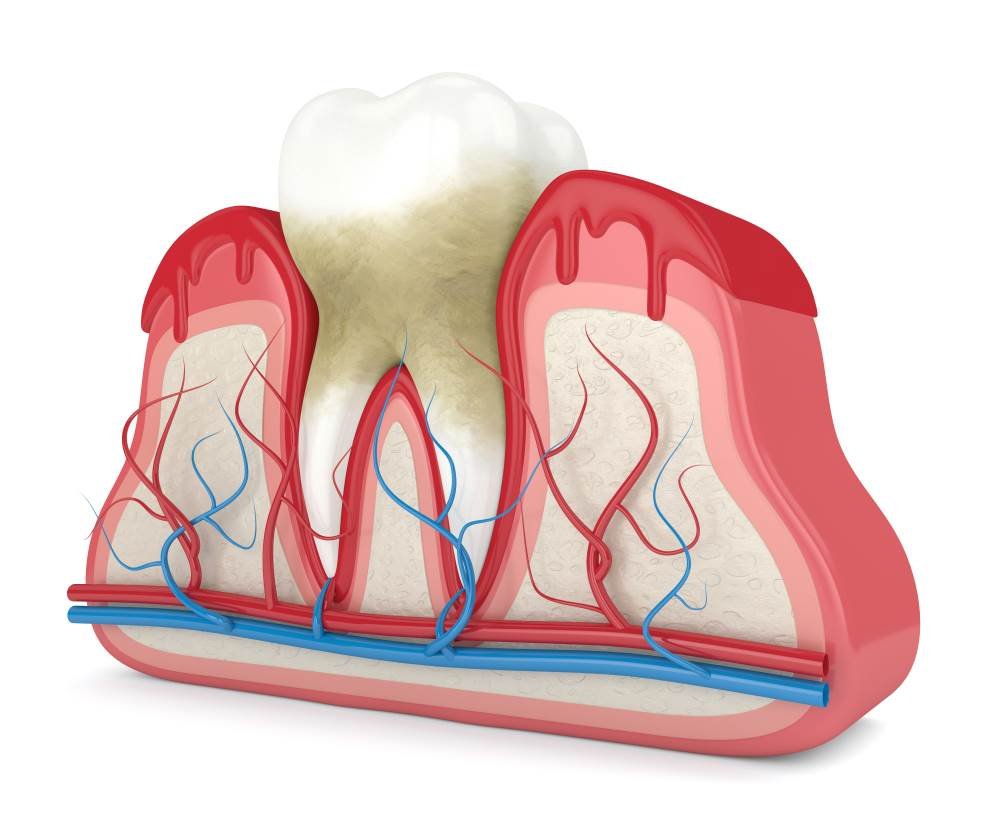 Causes Of Gum Disease