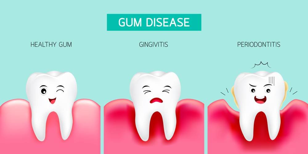 Gum Disease Dentist