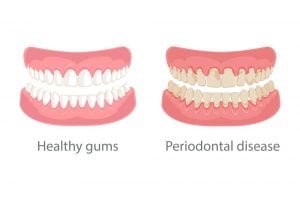 Symptoms Of Gum Disease